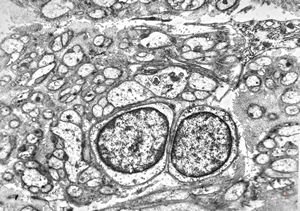 M,58y. | neurofibroma faciei M,58y. | neurofibroma faciei